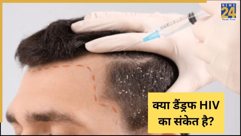 Hair Dandruff Is HIV