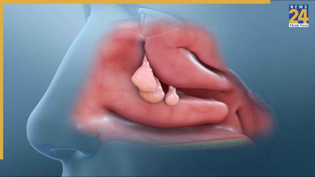 reasons of nose nasal polyps