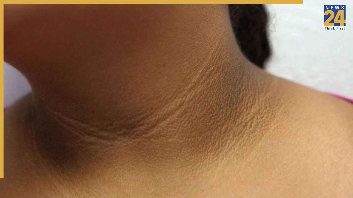 गर्दन पर जम गया काला मैल? इन टिप्स से करें तुरंत साफ… नहीं पड़ेगी पार्लर जाने की जरूरत