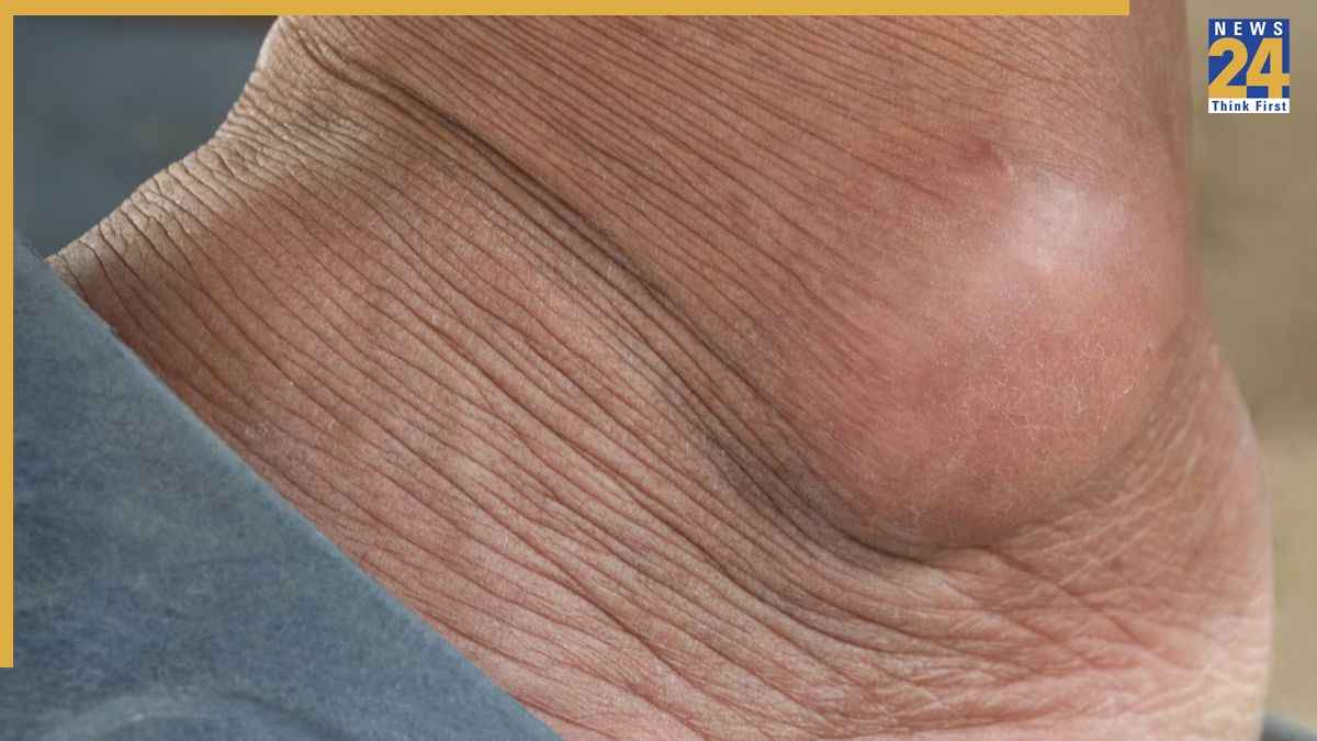 Early Sign Of Bone Cancer