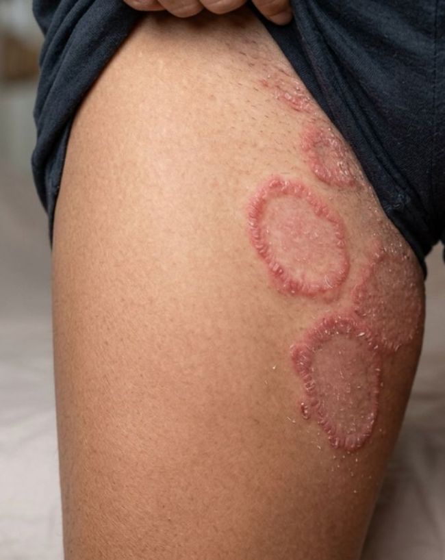 Rash And Bumps On Inner Thigh-1-2
