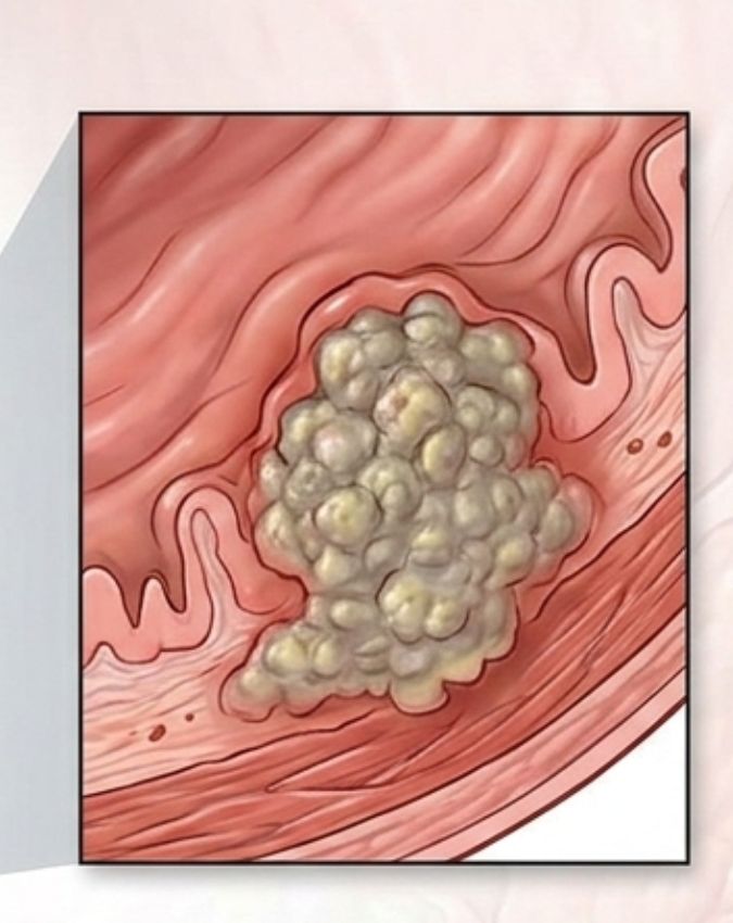 Stomach Cancer Symptoms Stomach Cancer Symptoms-1-2