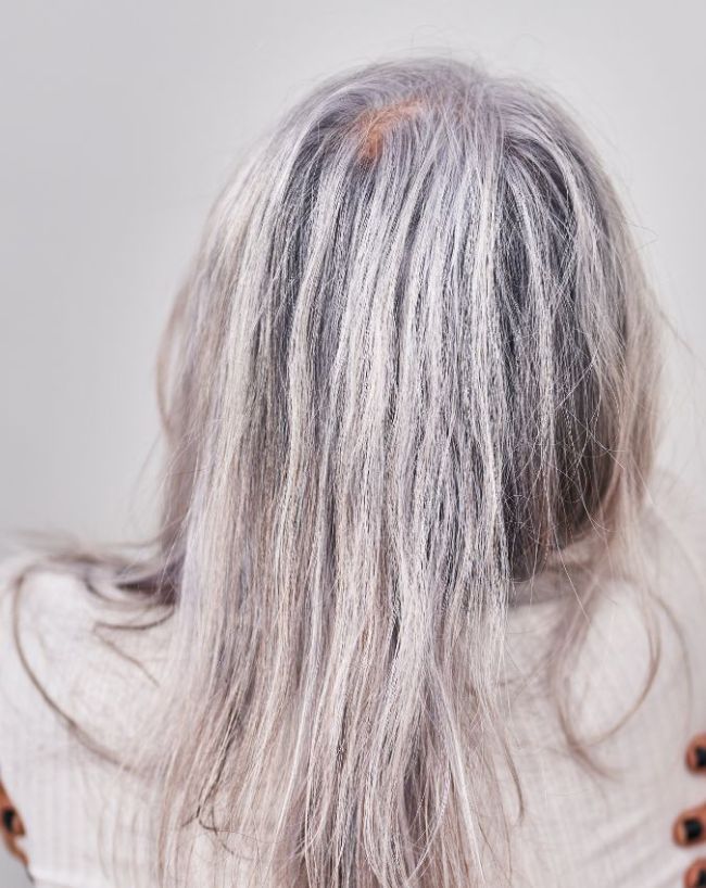 White Hair Causes-1-2-3-4-5