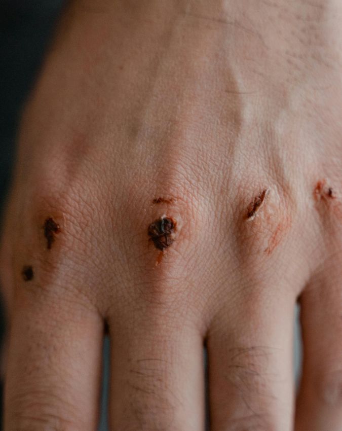 Vitamin D Ki Kami Ke Lakshan-1-2-3-4