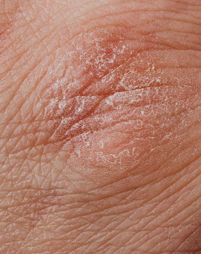 kidney Kharab Hone Ke Lakshan (6) kidney Kharab Hone Ke Lakshan (6)-1-2-3