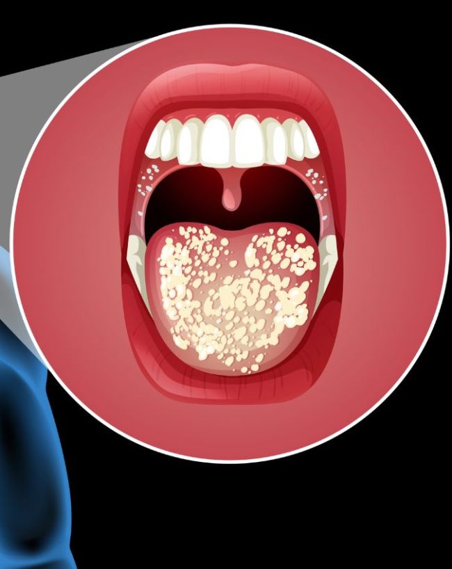 Muh Ke Cancer Ke Lakshan-1-2