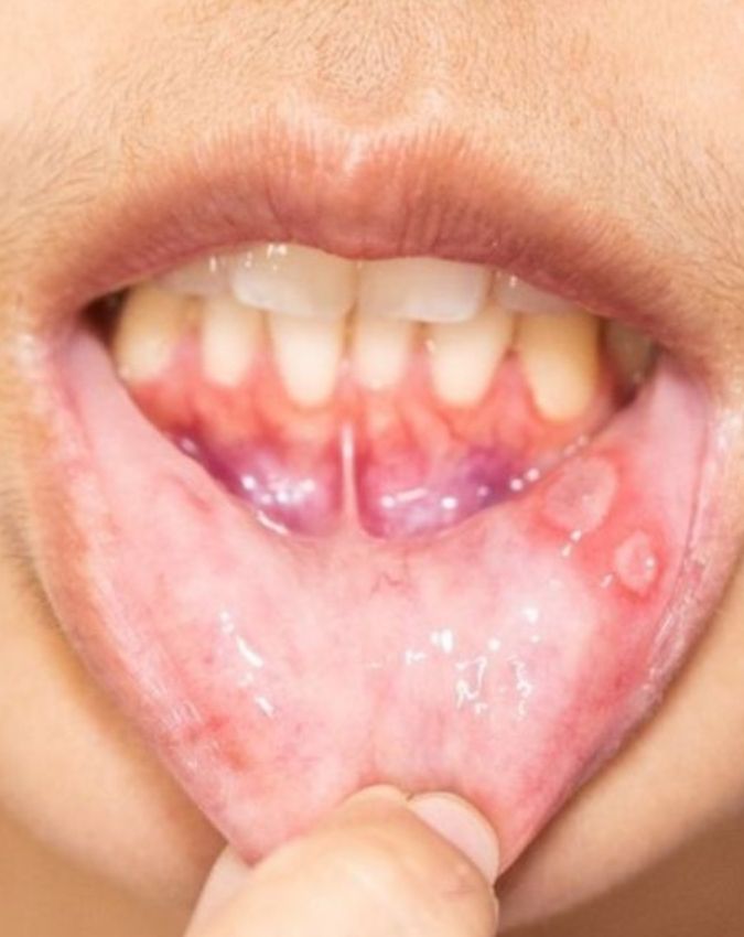 Vitamin B12 Deficiency Symptoms in hindi Vitamin B12 Deficiency Symptoms In Hindi-1-2-3-4-5