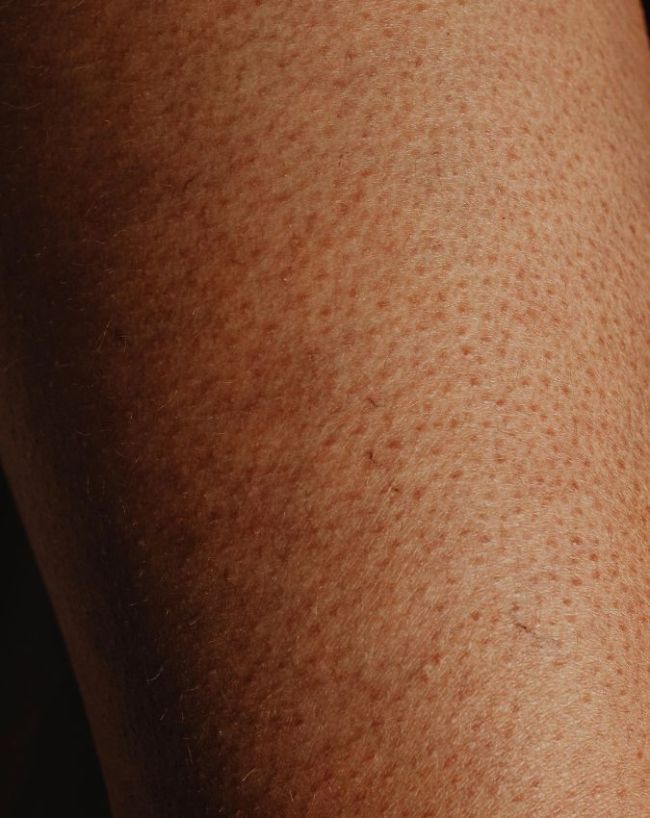 Rash And Bumps On Inner Thigh-1-2-3