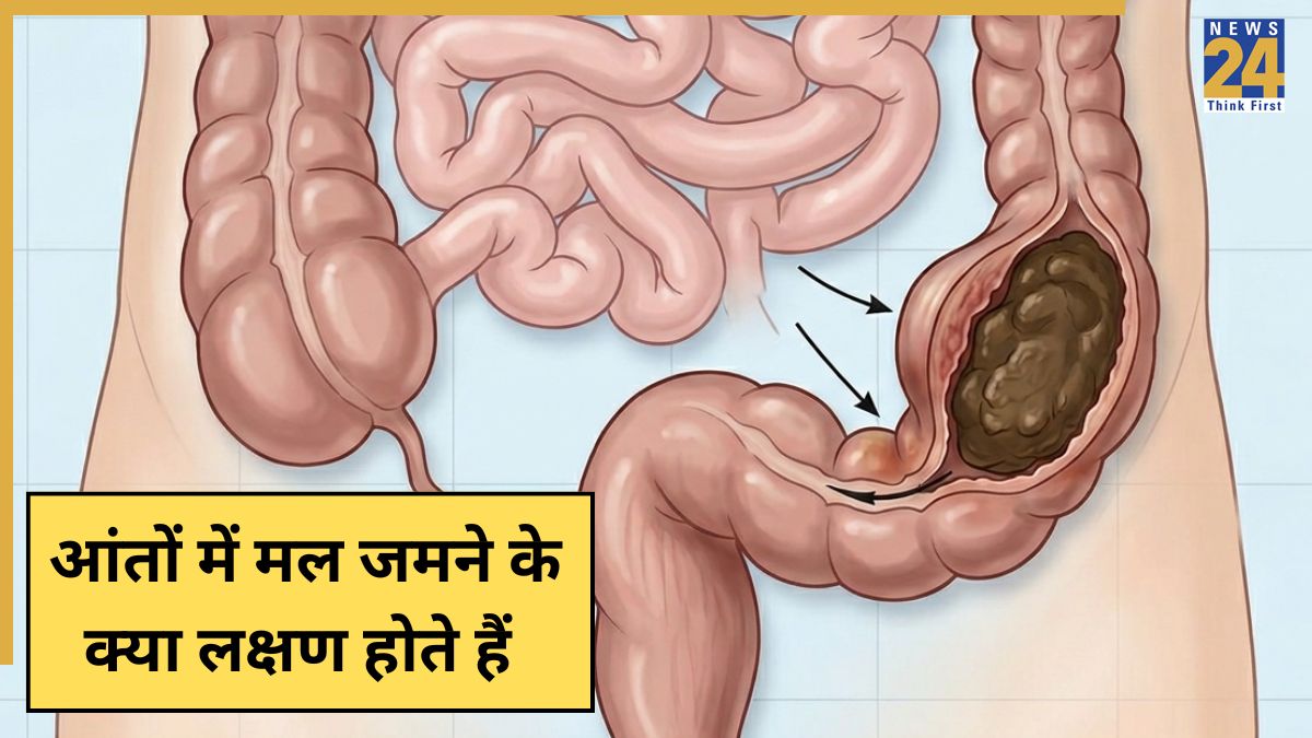 Aant me man jamne ke lakshan Aant Me Mal Jamne Ke Lakshan-1