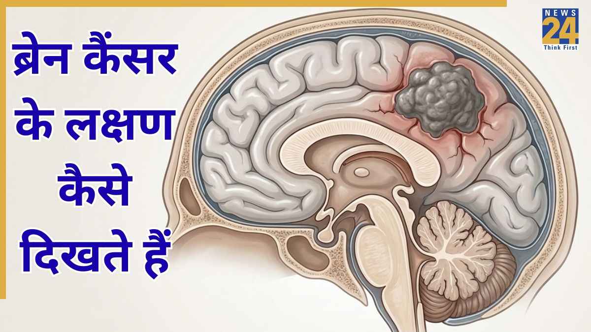 ब्रेन कैंसर के शुरुआती लक्षण क्या हैं? यहां जानिए Brain Cancer Symptoms कैसे दिखते हैं
