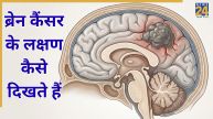 Brain Cancer Symptoms In Hindi