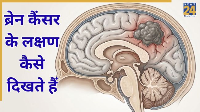 Brain Cancer Symptoms In Hindi