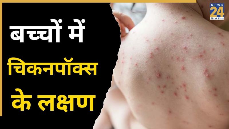 Chickenpox Ke Lakshan