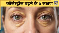Cholesterol Badhne Ke Lakshan High Cholesterol Symptoms