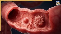 Colorectal Cancer