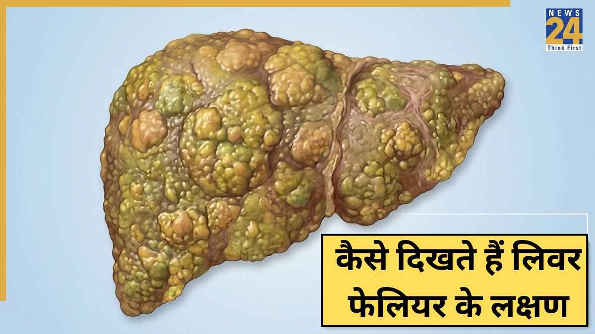 लिवर फेल होने से पहले शरीर देता है ये 5 संकेत, डॉक्टर ने बताए Liver Failure के लक्षण