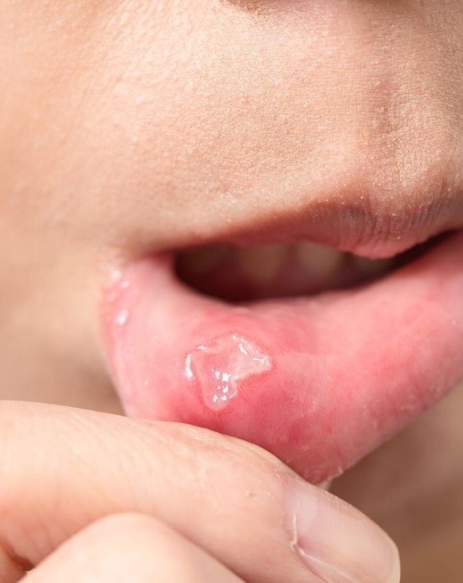 Mouth Cancer Symptoms-1-2