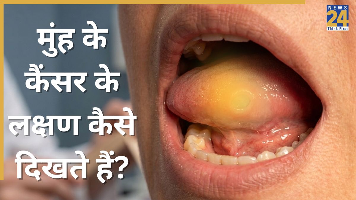Mouth Cancer Symptoms-1
