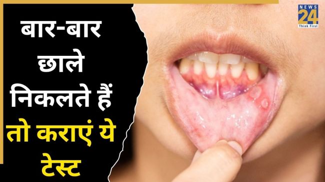 Mouth Ulcer Causes