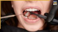 Teeth Cleaning Tips