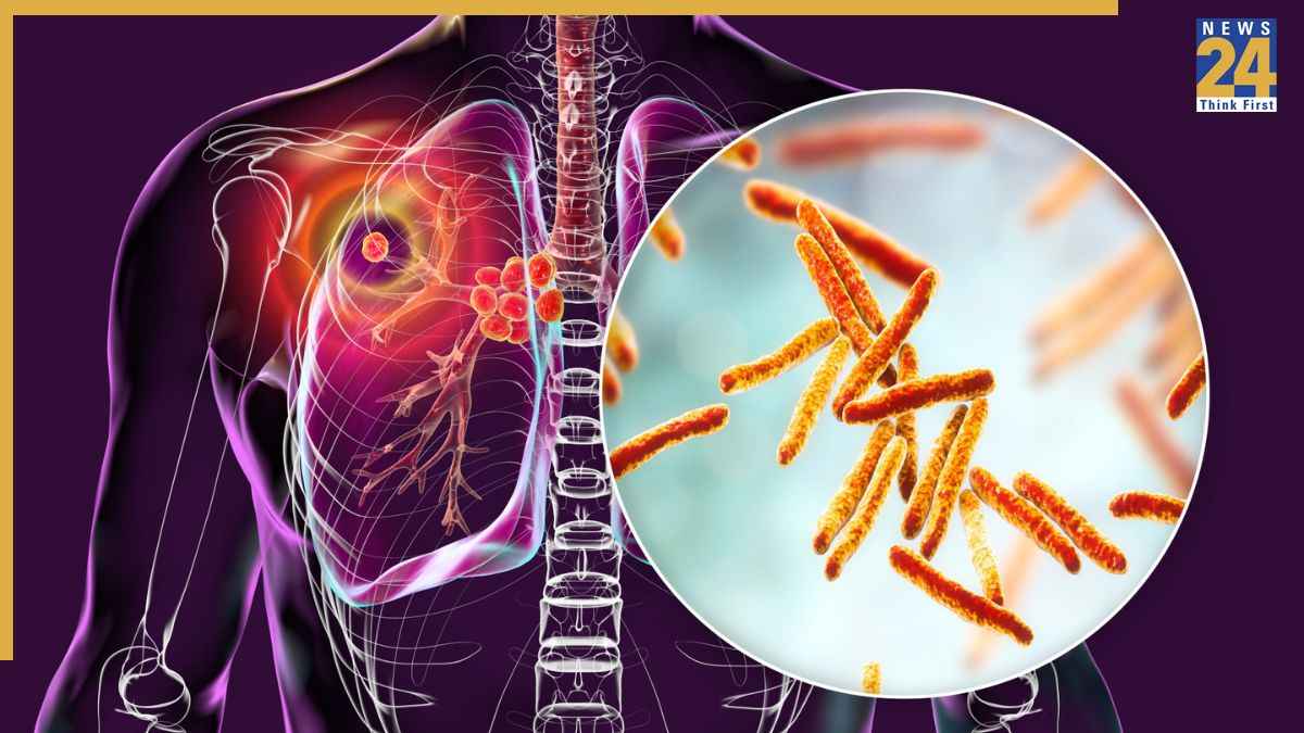 Tuberculosis prevention Tuberculosis prevention