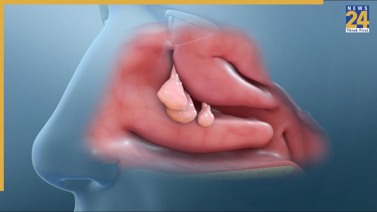 reasons of nose nasal polyps-1