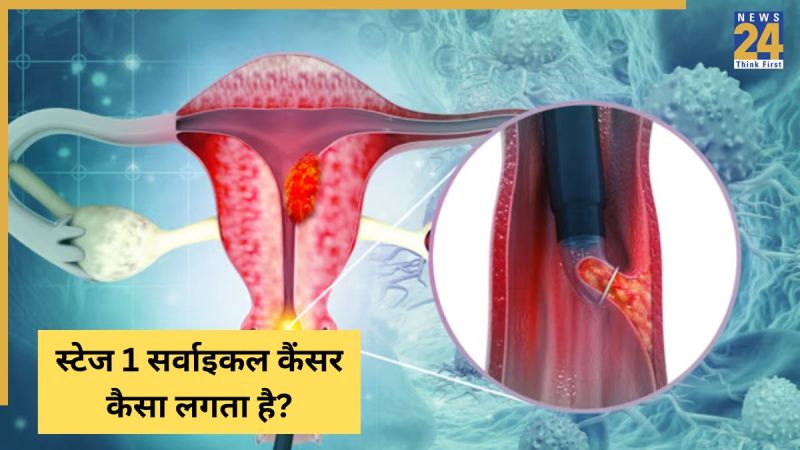 Cervical Cancer Kaise Hota Hai Cervical Cancer Kaise Hota Hai-1