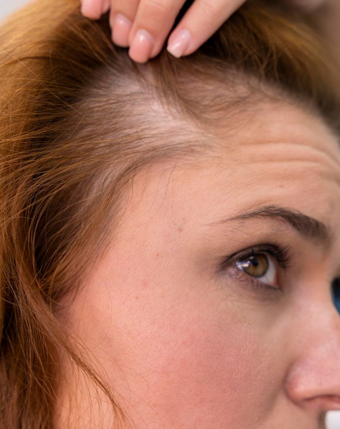 Which vitamin deficiency causes hair fall-1-2