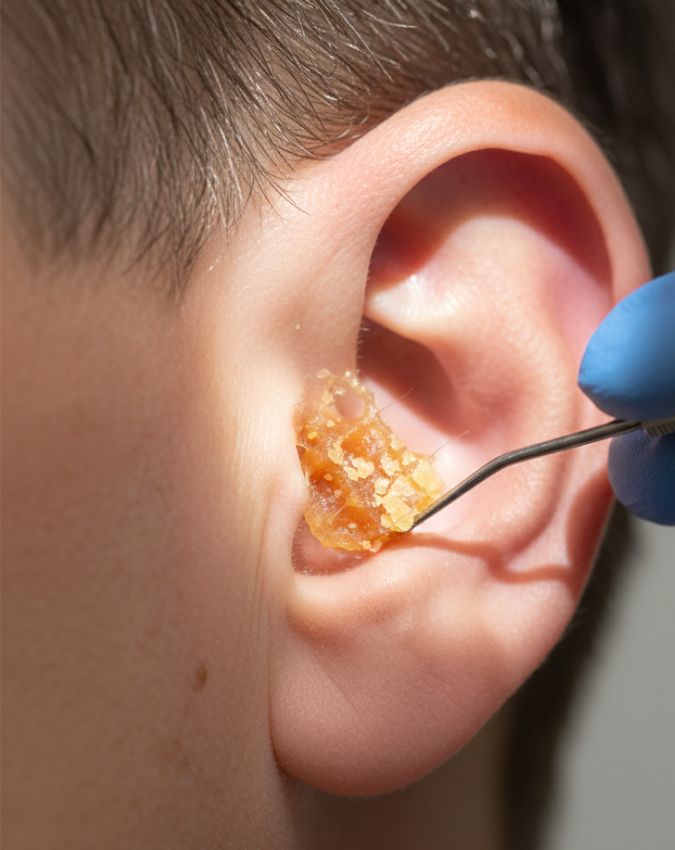 Earwax cleaning-1-2-3