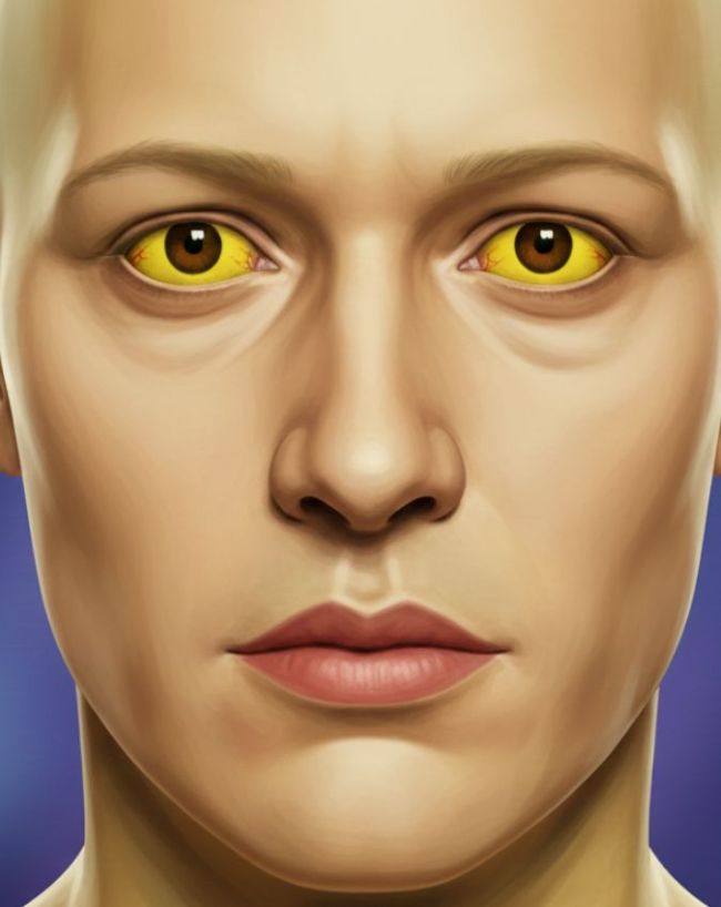 Liver Disease Symptoms-1-2-3-4