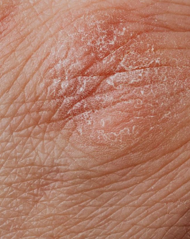 Diabetes gambhir hone ke lakshan-1-2-3-4