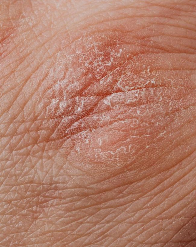 AC Side Effects In Hindi-1-2-3