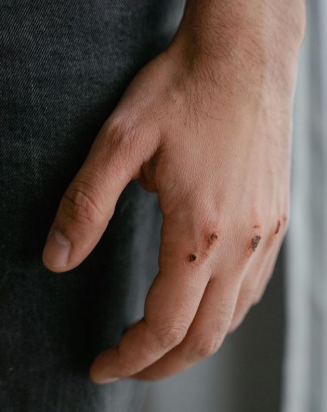 diseases caused by vitamin K deficiency-1-2