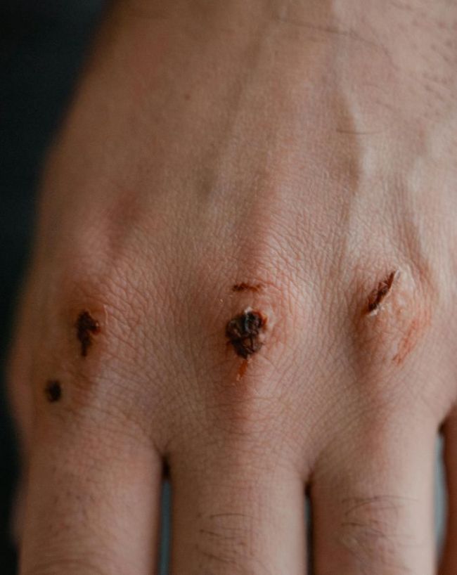 Liver Disease Symptoms-1-2-3-4-5