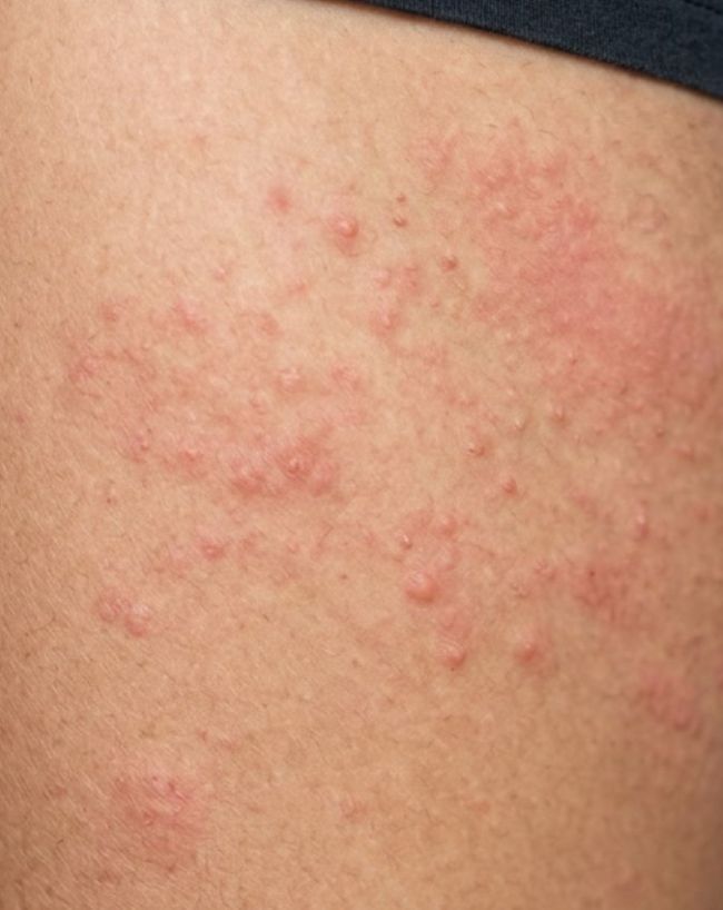 Diabetes gambhir hone ke lakshan-1-2-3