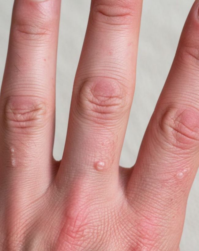 uric acid badhne ke lakshan-1-2-3-4-5