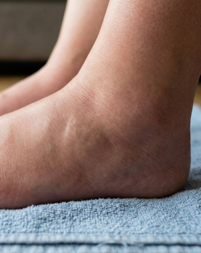 Swollen Feet causes-1-2-3-4-5-6-7