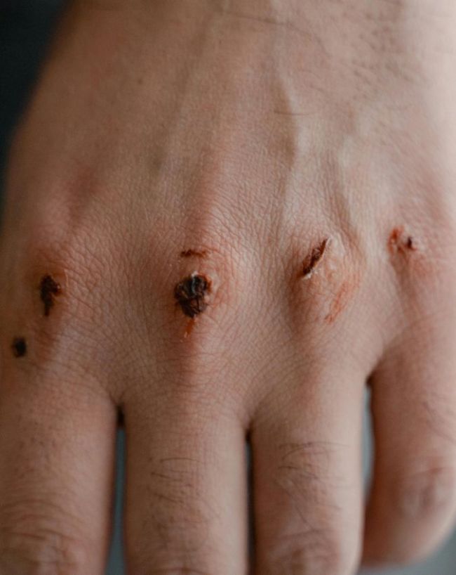 Diabetes gambhir hone ke lakshan-1-2-3-4-5