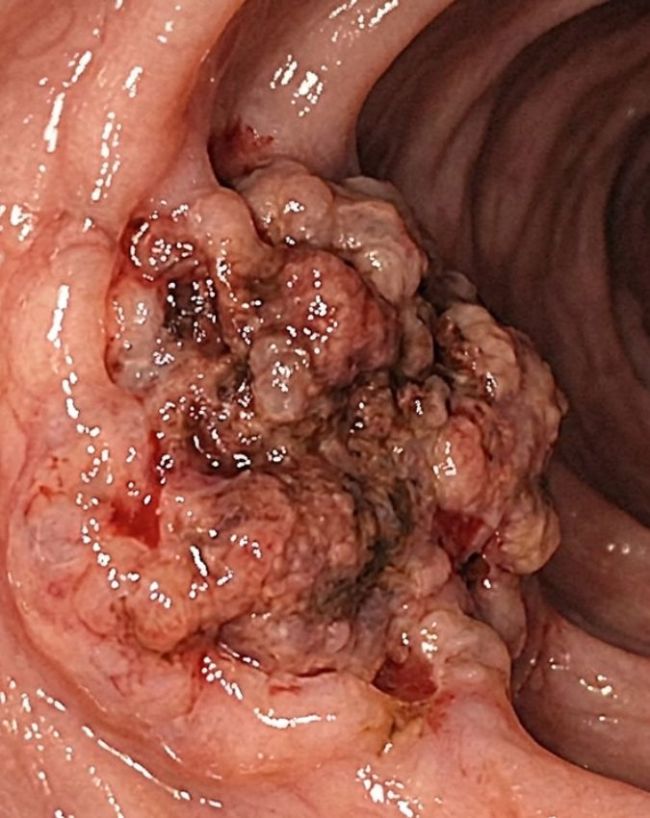 Aant Ke Cancer Ke Lakshan-1-2-3