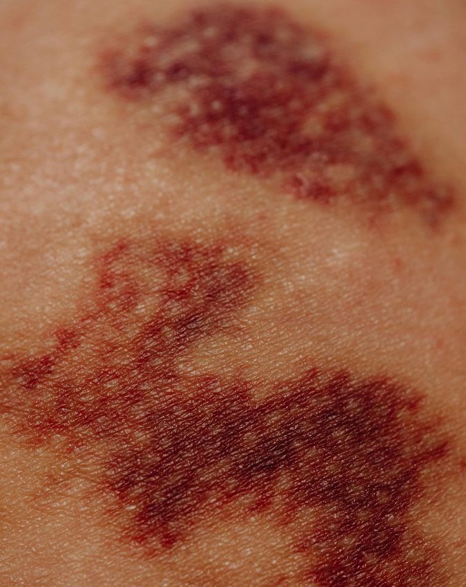 HIV ke lakshan-1-2-3-4-5