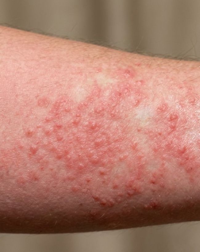 HIV AIDS Symptoms In Women-1-2-3