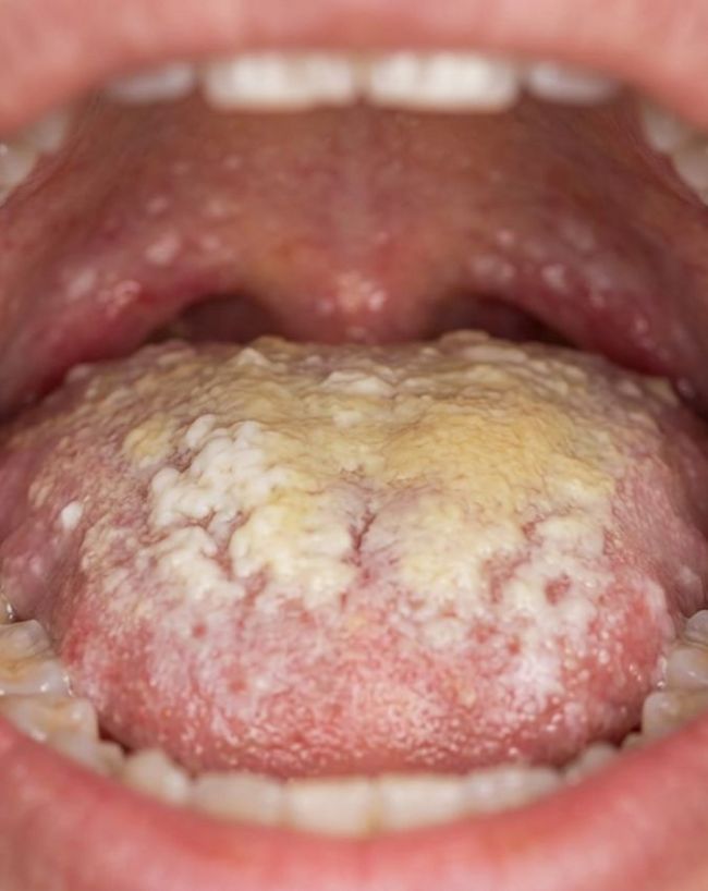 HIV AIDS Symptoms In Women-1-2-3-4-5-6