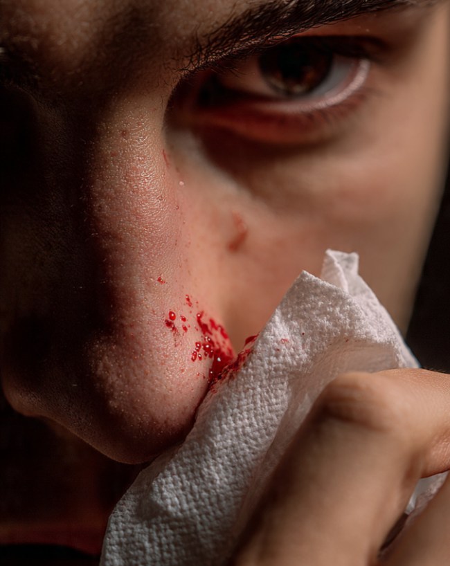 Hemophilia men Problem Bleeding-1-2-3-4-5