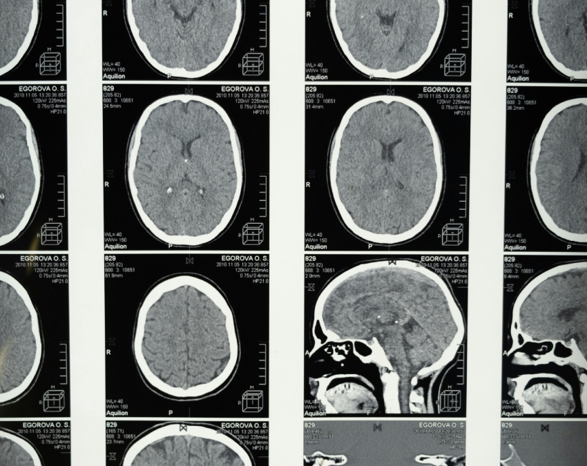 Brain Tumor Symptoms -1-2-3-4-5-6-7-8-9-10-11