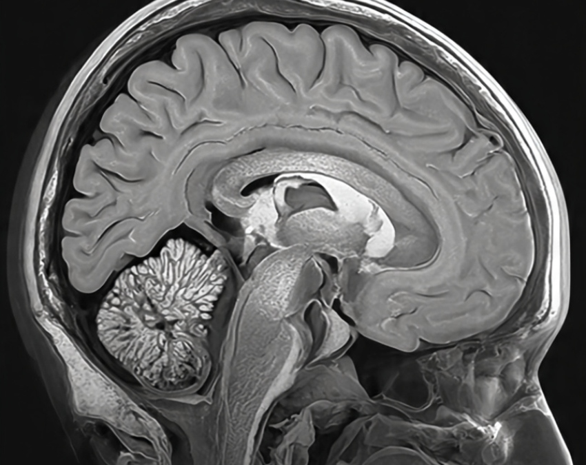 Brain Tumor Symptoms -1-2-3-4-5