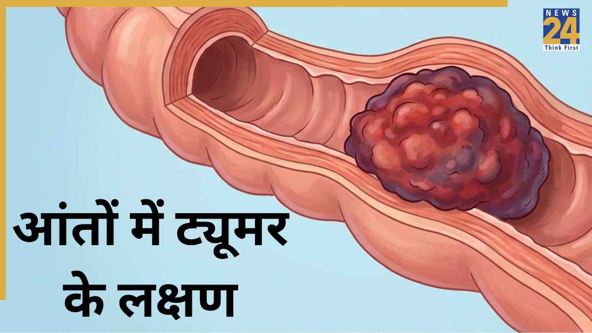 Aant Ke Cancer Ke Lakshan Aant Ke Cancer Ke Lakshan