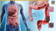 Colorectal Cancer Diabetes Link