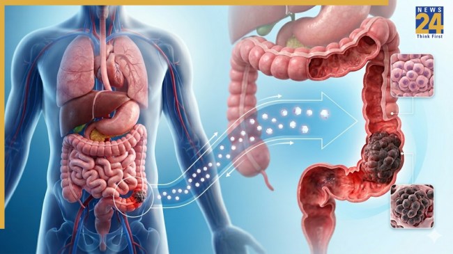 Colorectal Cancer Diabetes Link