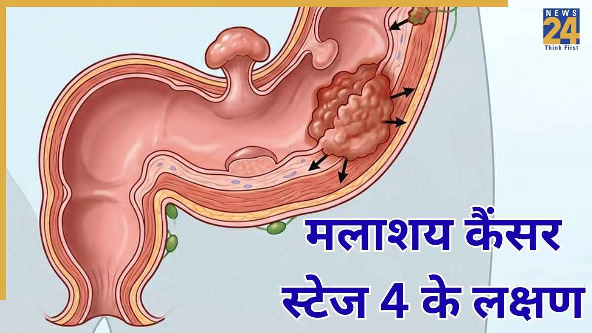 मलाशय कैंसर की आखिरी स्टेज में क्या होता है? जानिए कैसे दिखते हैं Colorectal Cancer Stage 4 के लक्षण