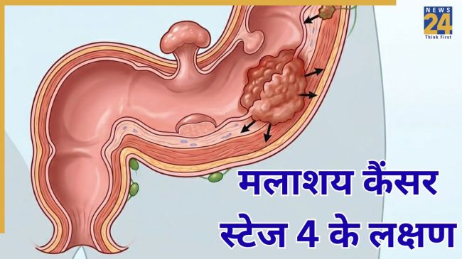 Colorectal cancer